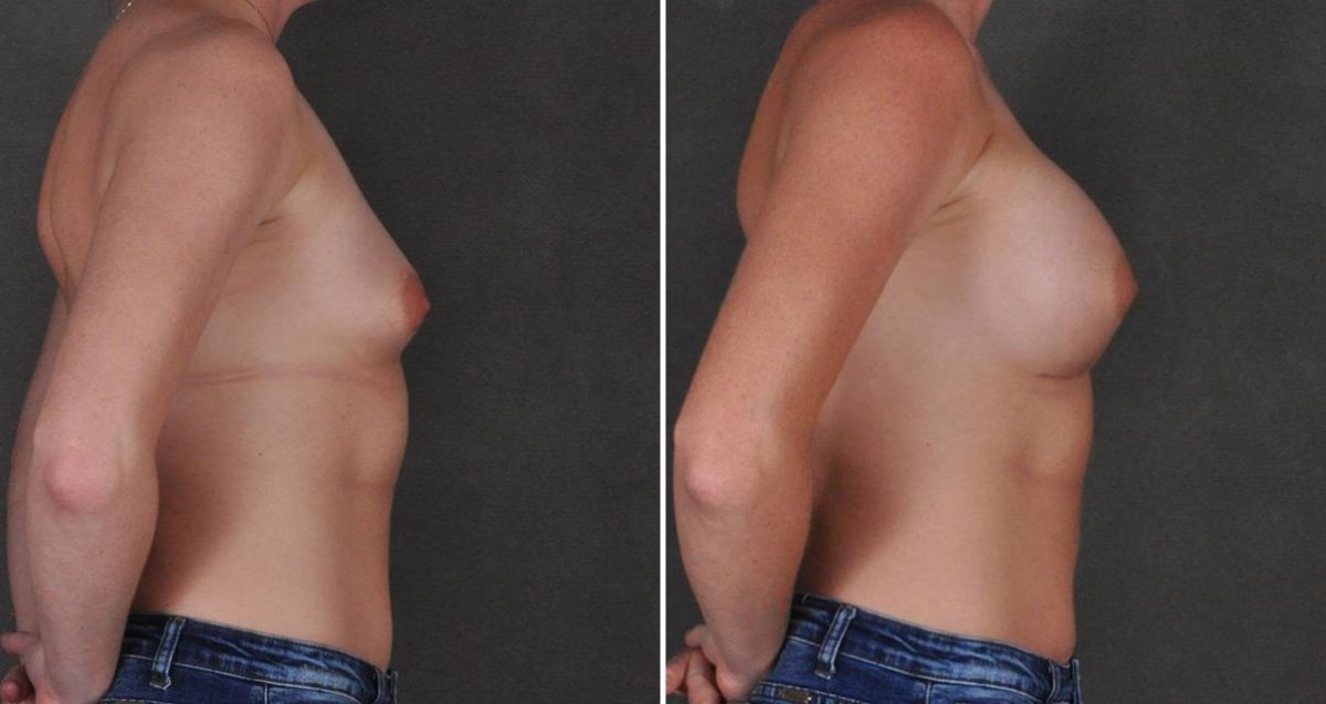 Breast Augmentation Before and After Photos in Omaha, NE, Case 10311