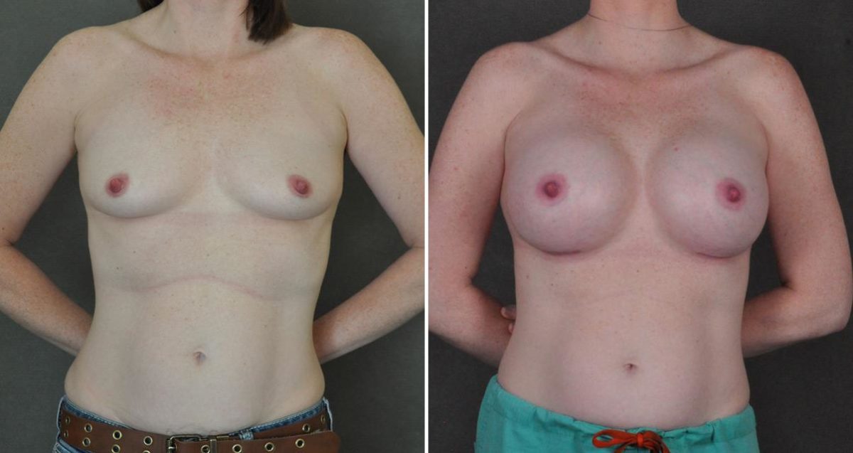 Breast Augmentation Before and After Photos in Omaha, NE, Case 10312