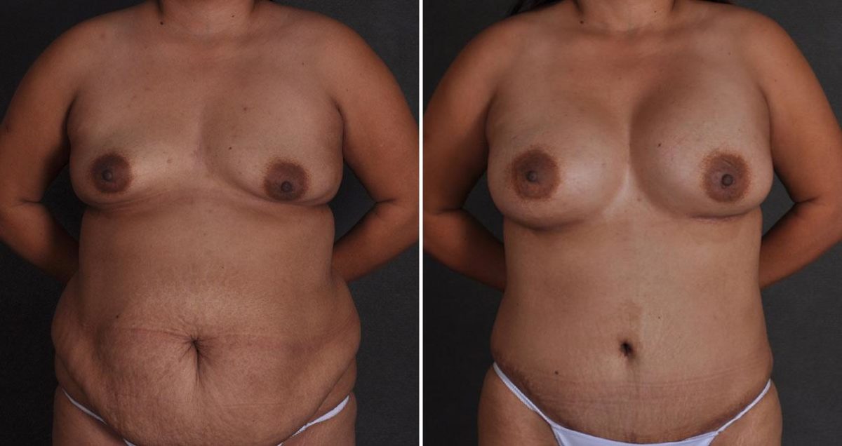 Breast Augmentation Before and After Photos in Omaha, NE, Case 9851