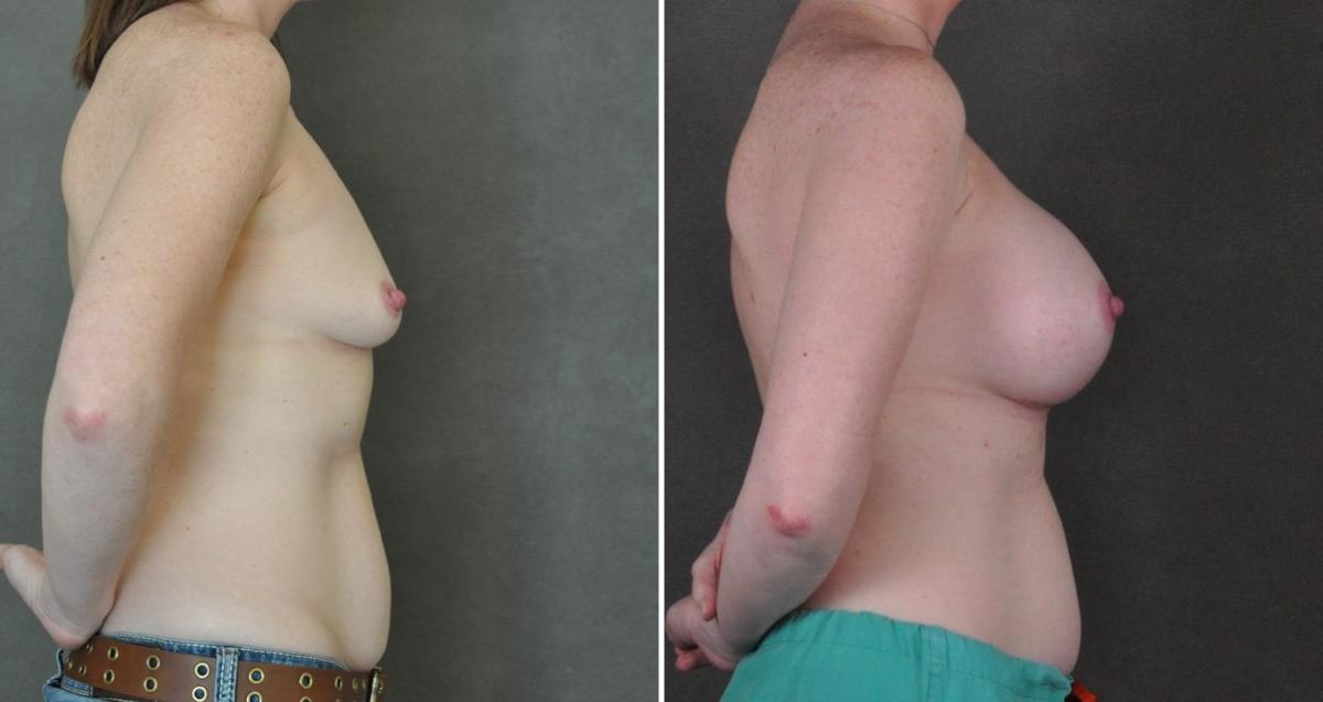 Breast Augmentation Before and After Photos in Omaha, NE, Case 10312