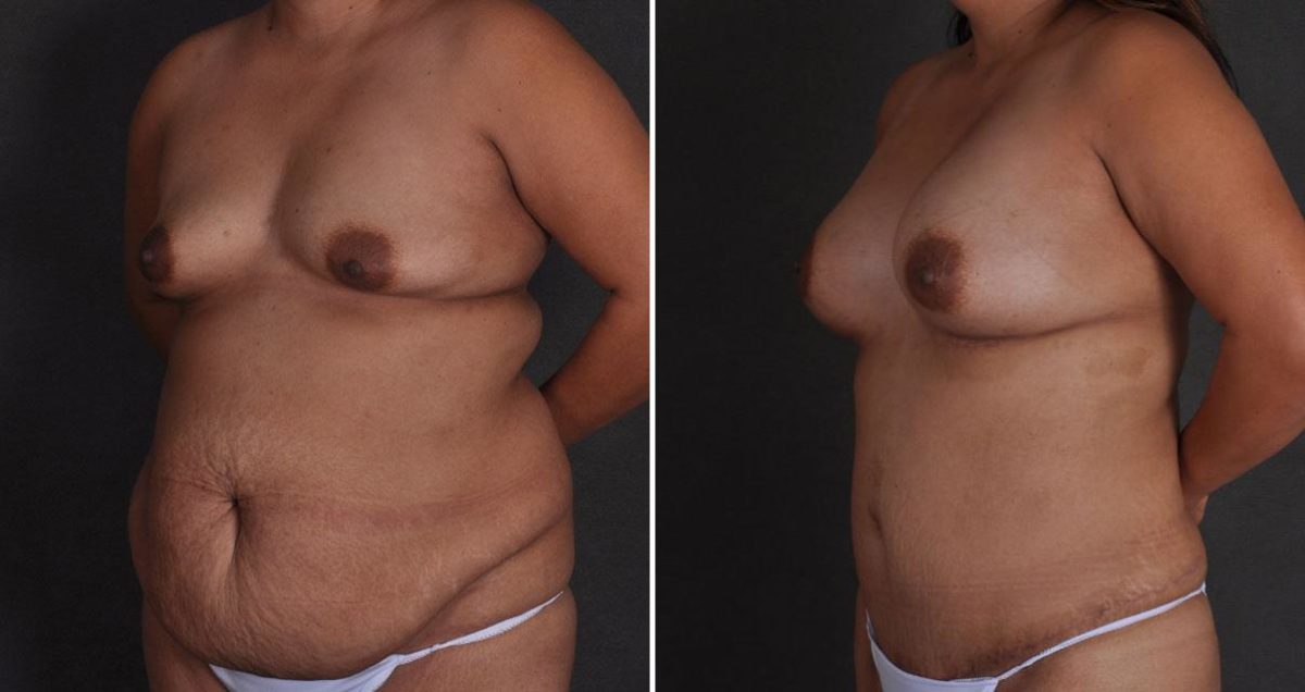 Breast Augmentation Before and After Photos in Omaha, NE, Case 9851