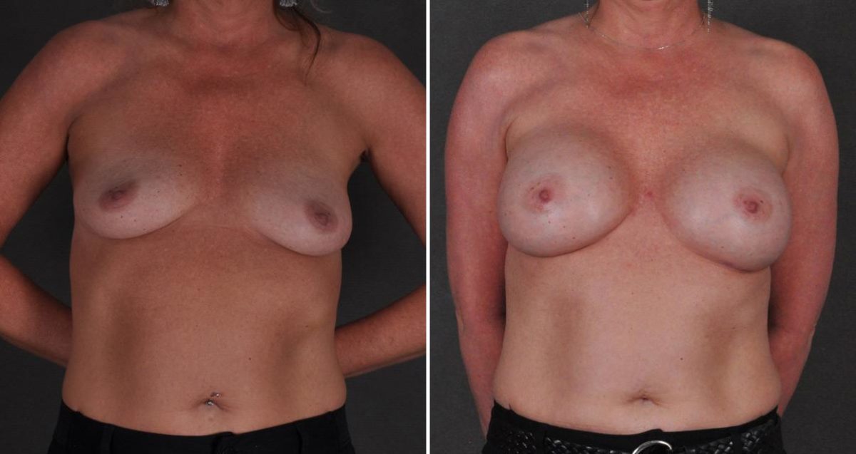 Breast Augmentation Before and After Photos in Omaha, NE, Case 10335