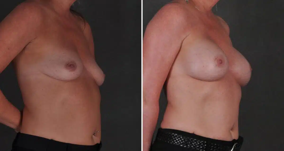 Breast Augmentation Before and After Photos in Omaha, NE, Case 10335