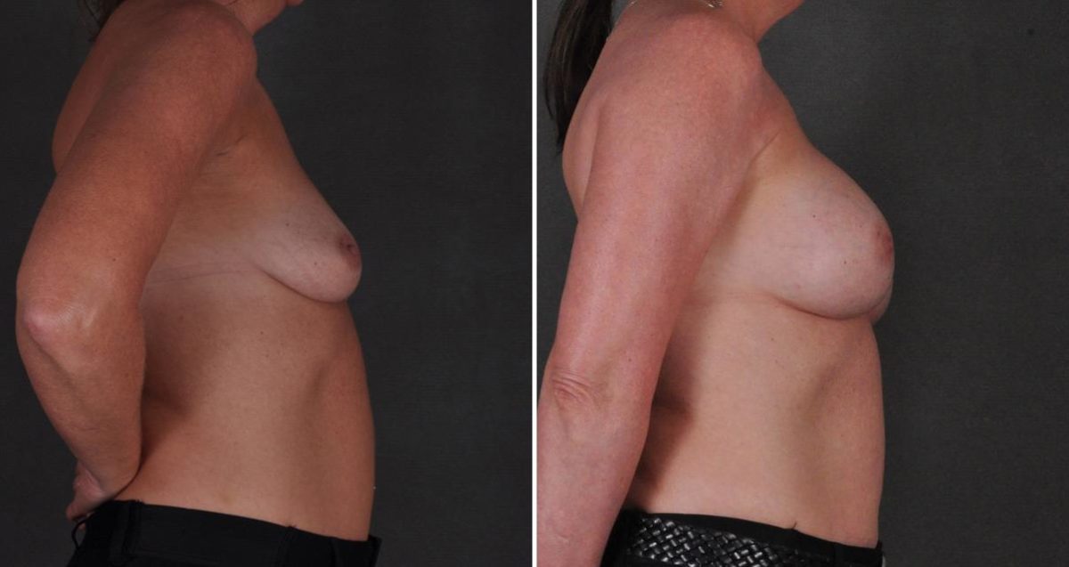 Breast Augmentation Before and After Photos in Omaha, NE, Case 10335