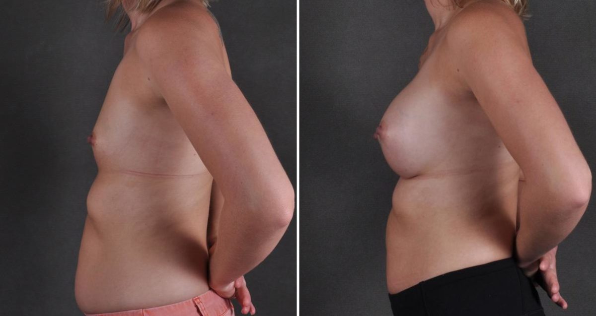 Breast Augmentation Before and After Photos in Omaha, NE, Case 10275