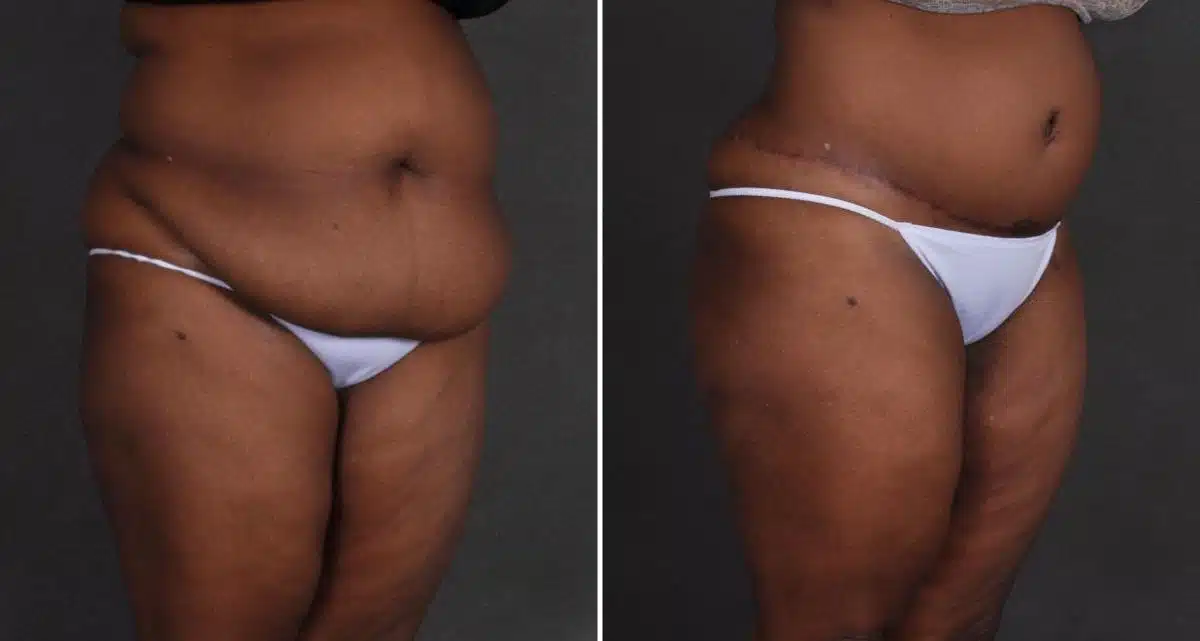 Tummy Tuck Before and After Photos in Omaha, NE, Case 9877