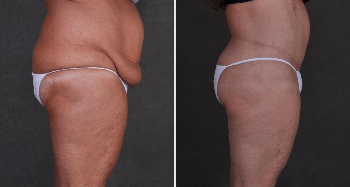 Case 9897, Tummy Tuck Before and After Photos Tummy Tuck Before and After Photos in Omaha, NE, Case 9897