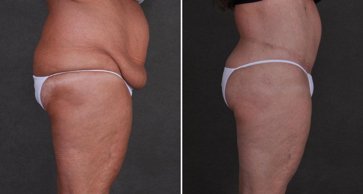 Tummy Tuck Before and After Photos in Omaha, NE, Case 9897