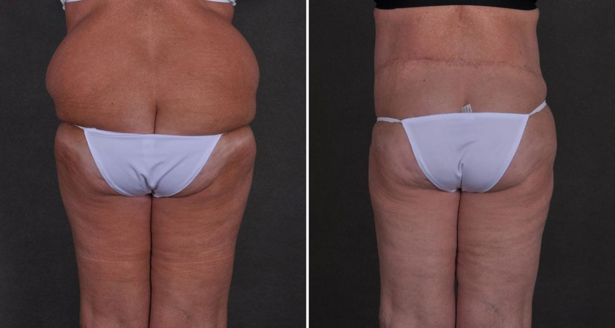 Tummy Tuck Before and After Photos in Omaha, NE, Case 9897