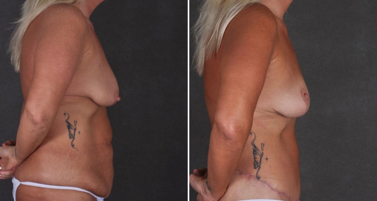 Tummy Tuck Before and After Photos in Omaha, NE, Case 9923