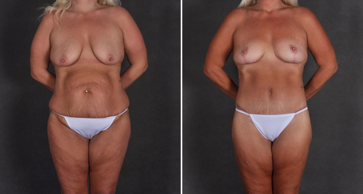 Tummy Tuck Before and After Photos in Omaha, NE, Case 9923