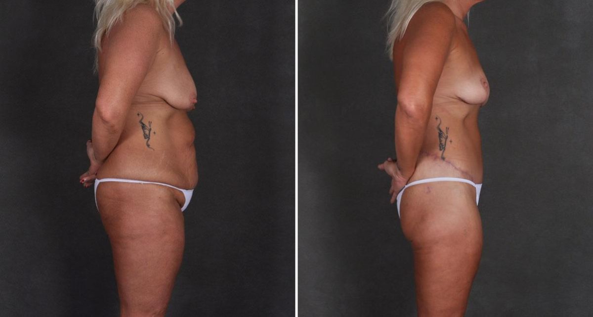 Case 9923, Tummy Tuck Before and After Photos Tummy Tuck Before and After Photos in Omaha, NE, Case 9923