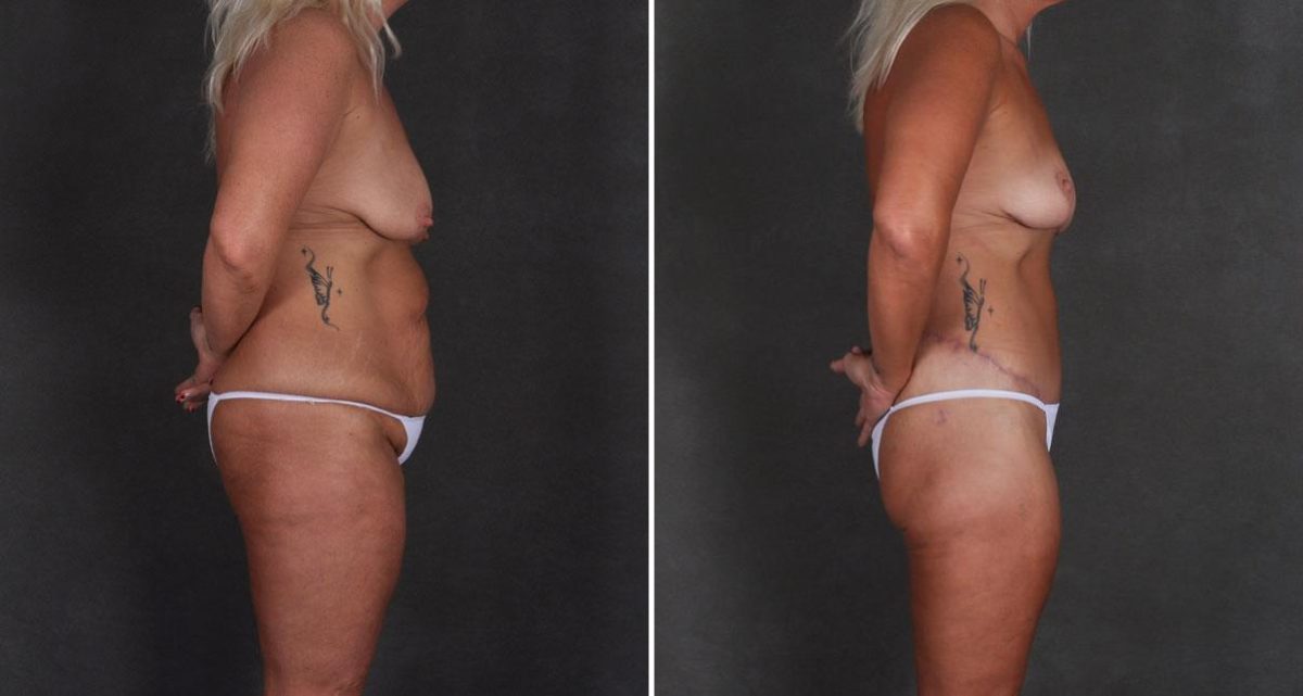 Tummy Tuck Before and After Photos in Omaha, NE, Case 9923