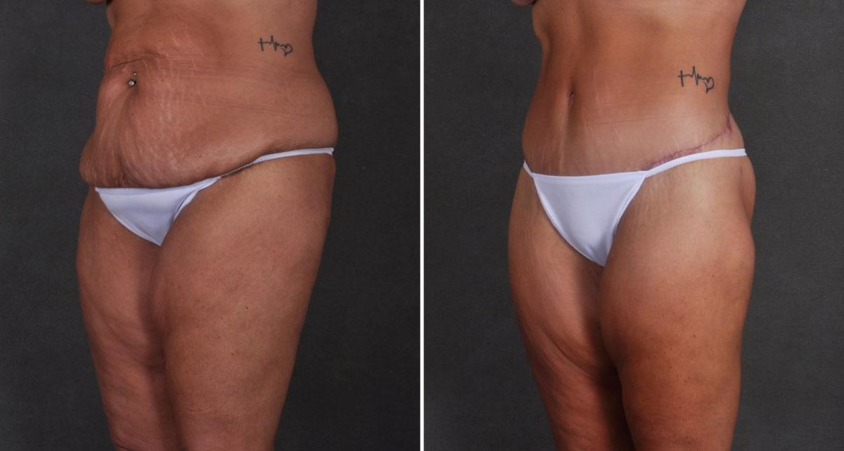 Tummy Tuck Before and After Photos in Omaha, NE, Case 9923