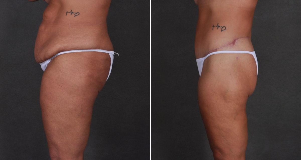 Tummy Tuck Before and After Photos in Omaha, NE, Case 9923