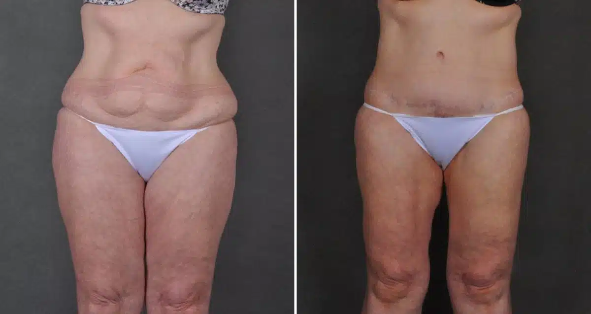 Tummy Tuck Before and After Photos in Omaha, NE, Case 10357