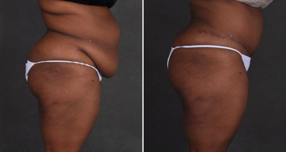 Tummy Tuck Before and After Photos in Omaha, NE, Case 9877