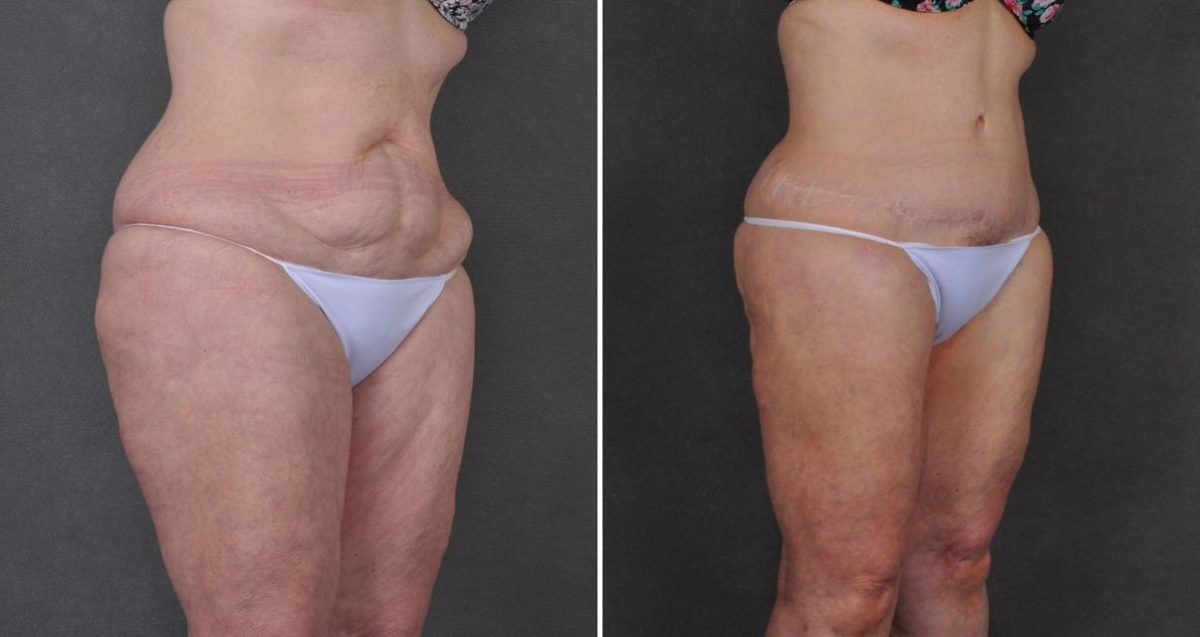 Tummy Tuck Before and After Photos in Omaha, NE, Case 10357