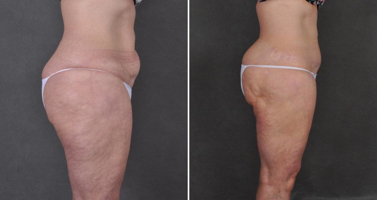 Tummy Tuck Before and After Photos in Omaha, NE, Case 10357