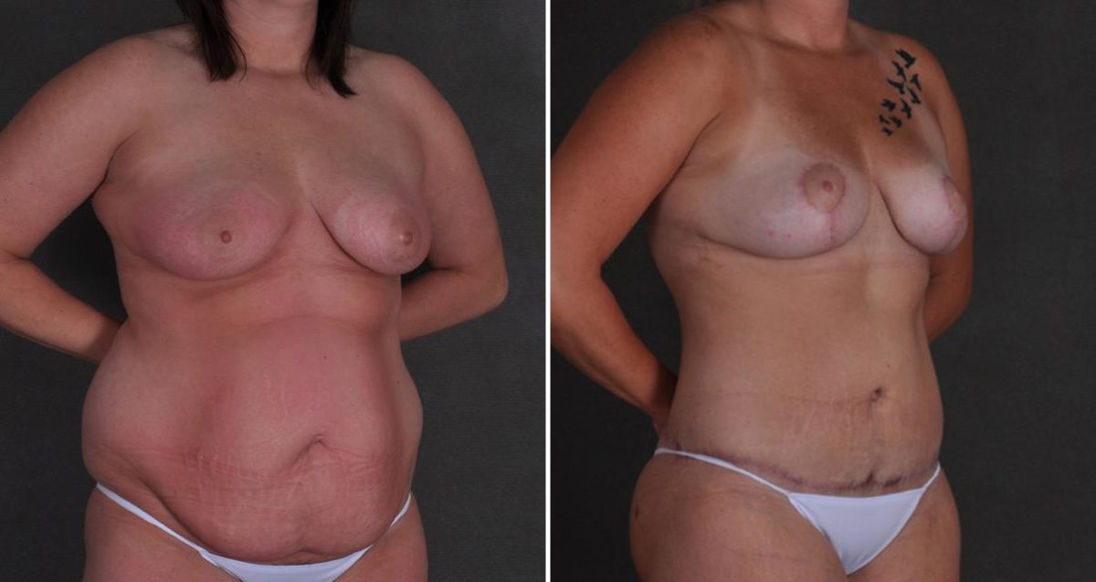 Tummy Tuck Before and After Photos in Omaha, NE, Case 10384