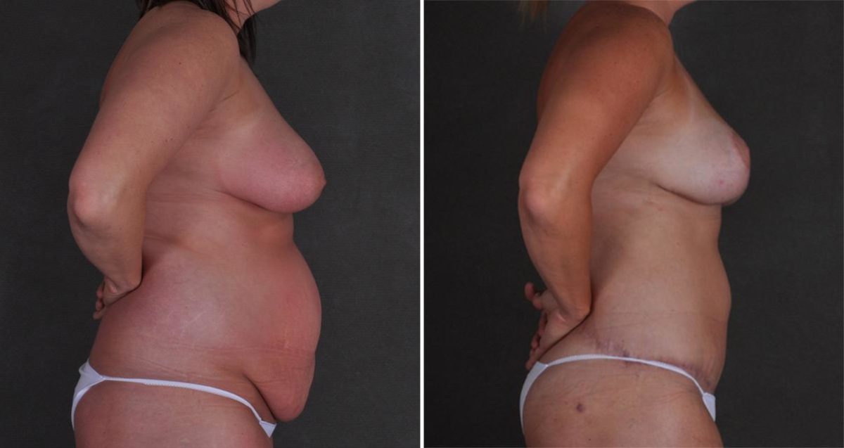 Tummy Tuck Before and After Photos in Omaha, NE, Case 10384