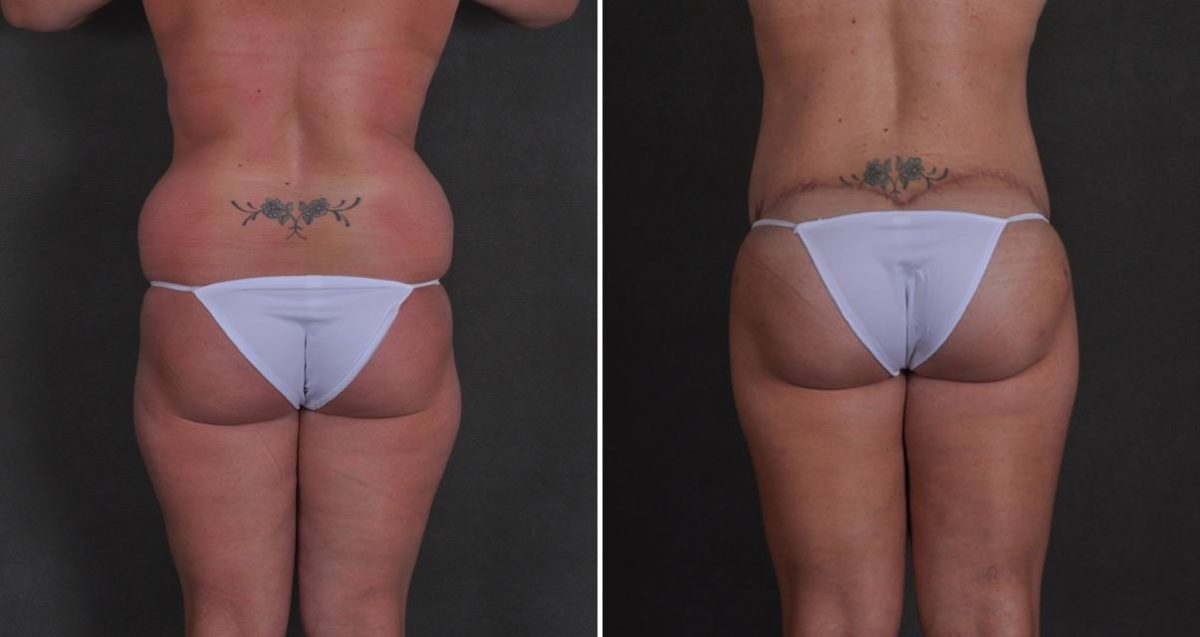 Tummy Tuck Before and After Photos in Omaha, NE, Case 10384