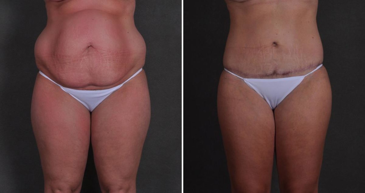 Tummy Tuck Before and After Photos in Omaha, NE, Case 10384