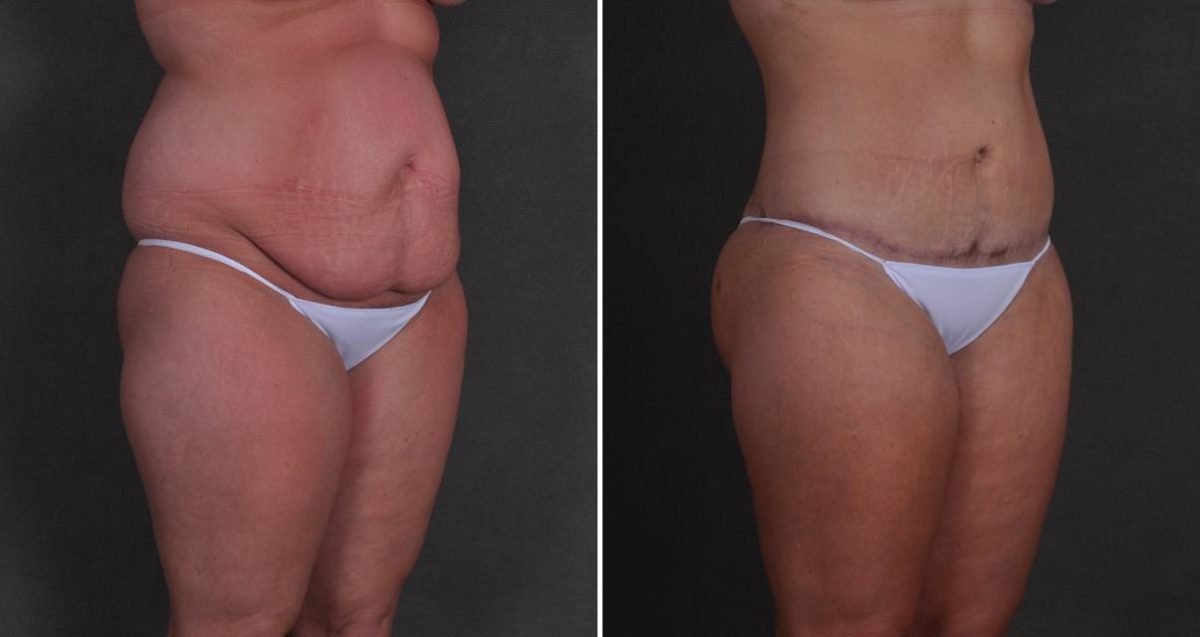 Tummy Tuck Before and After Photos in Omaha, NE, Case 10384