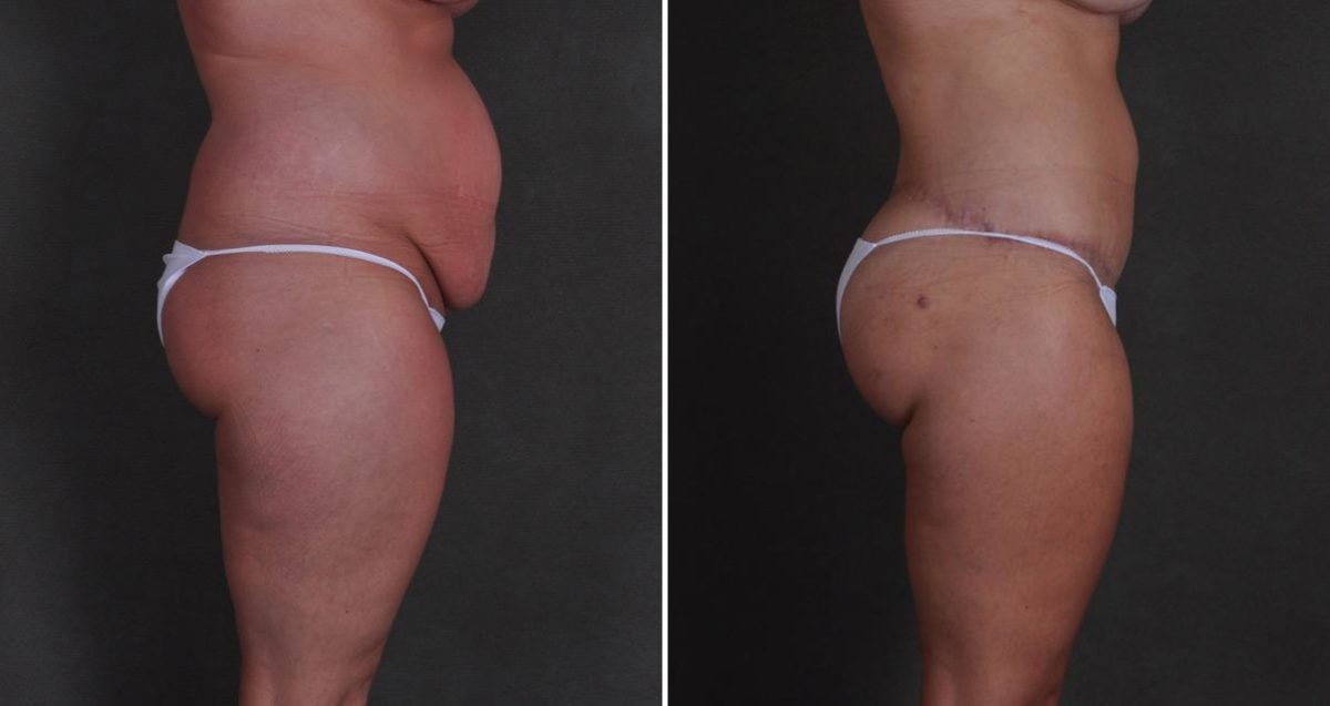 Tummy Tuck Before and After Photos in Omaha, NE, Case 10384