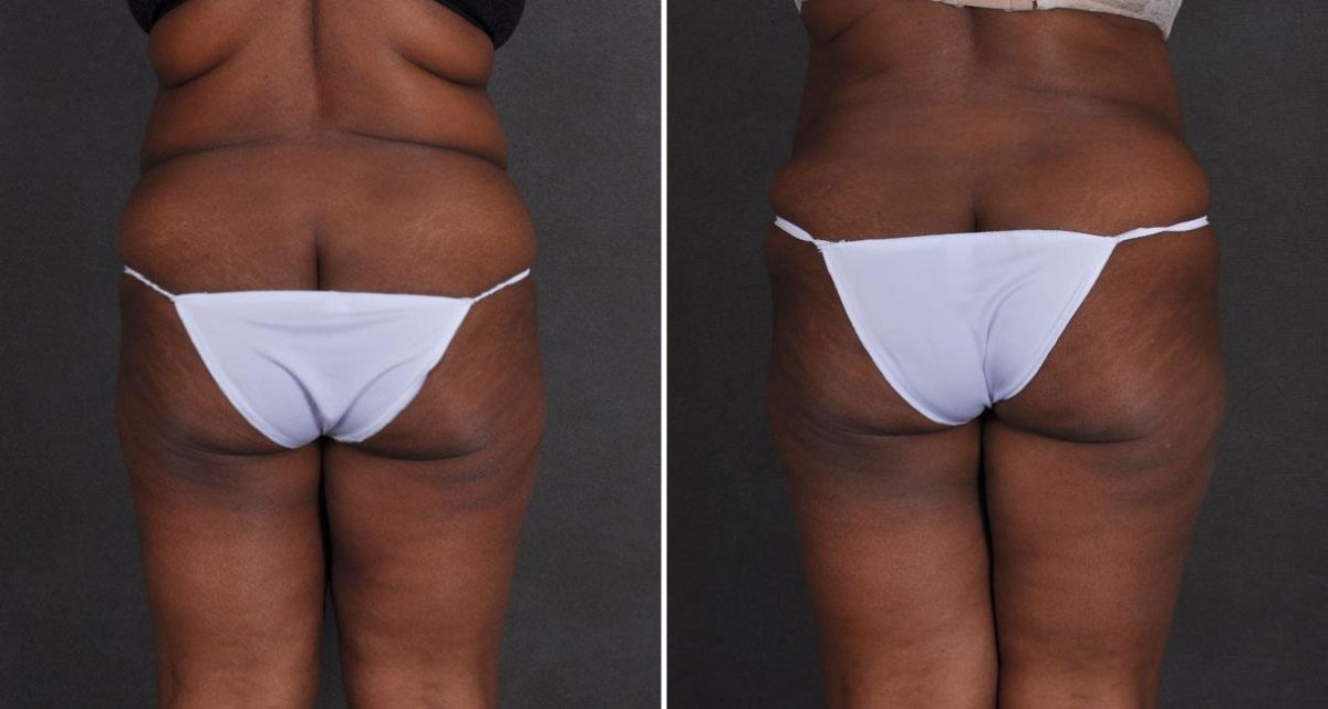 Case 9877, Tummy Tuck Before and After Photos Tummy Tuck Before and After Photos in Omaha, NE, Case 9877