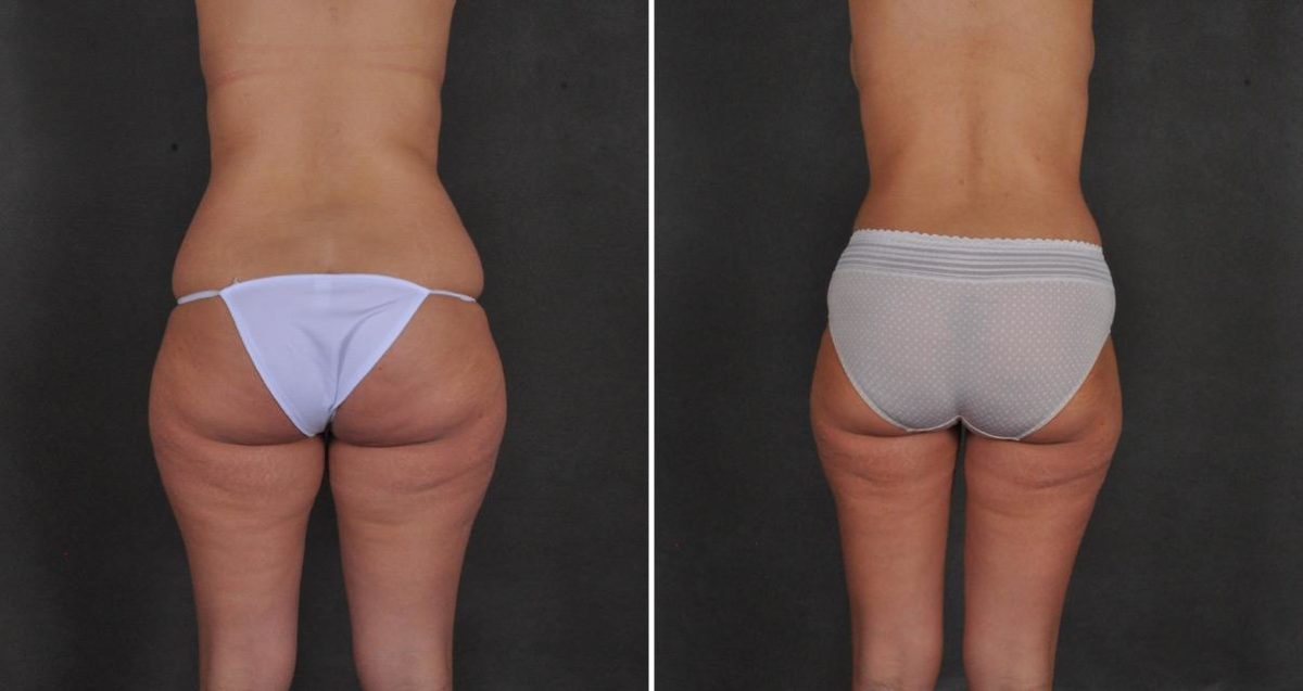 Case 10402, Tummy Tuck Before and After Photos Tummy Tuck Before and After Photos in Omaha, NE, Case 10402