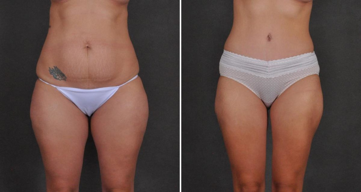 Case 10402, Tummy Tuck Before and After Photos Tummy Tuck Before and After Photos in Omaha, NE, Case 10402