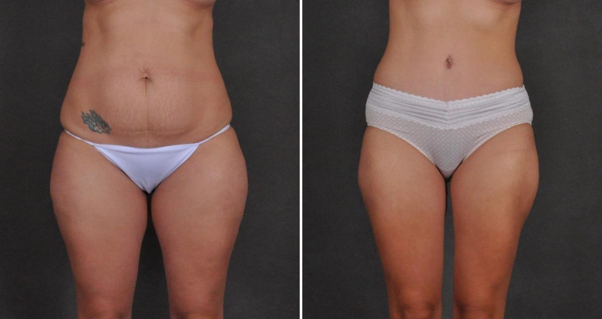 Tummy Tuck Before and After Photos in Omaha, NE, Case 10402