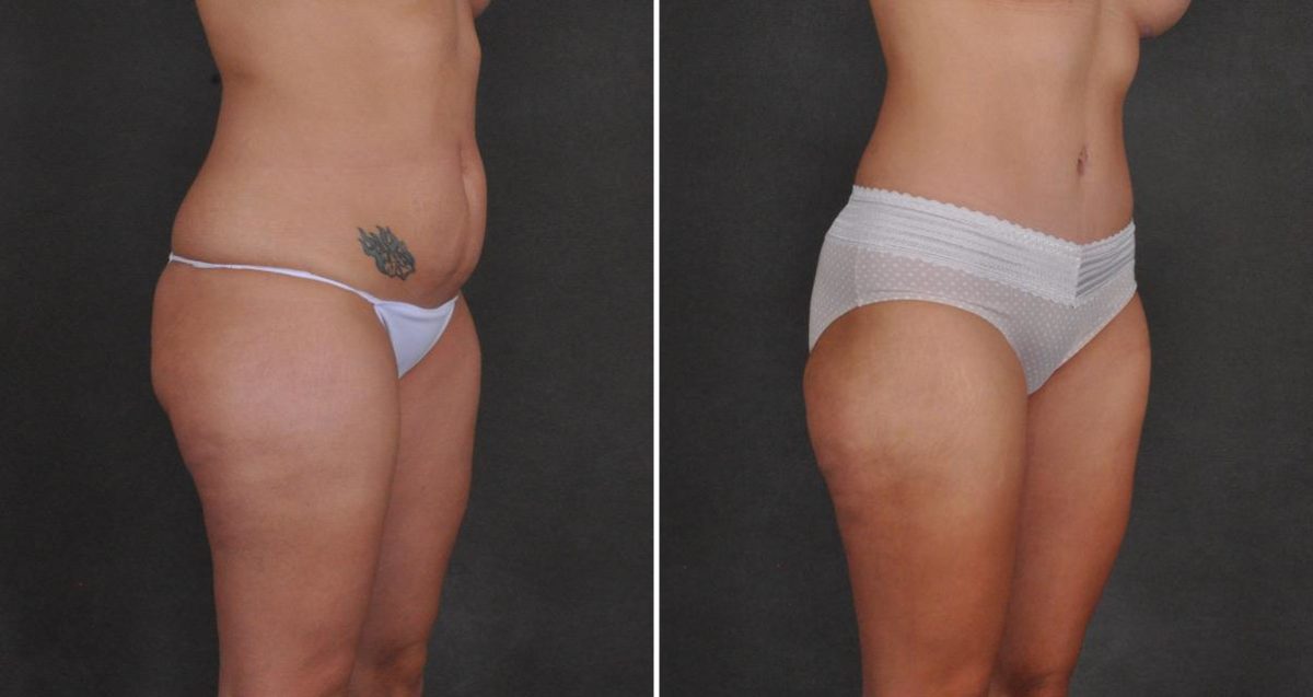 Tummy Tuck Before and After Photos in Omaha, NE, Case 10402