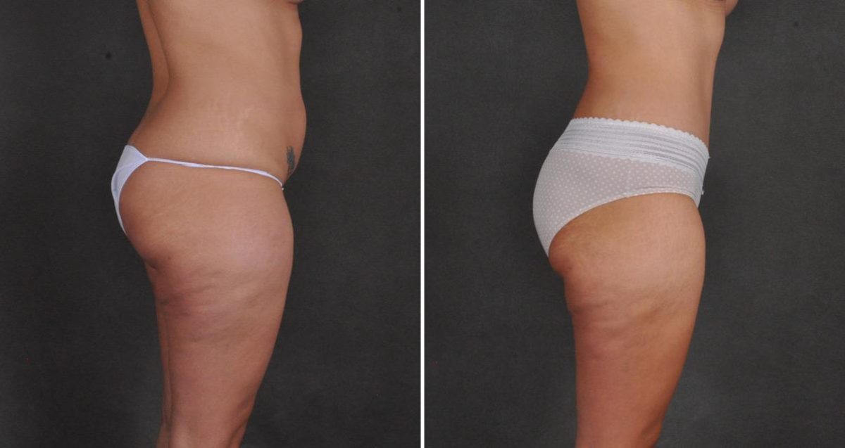 Tummy Tuck Before and After Photos in Omaha, NE, Case 10402