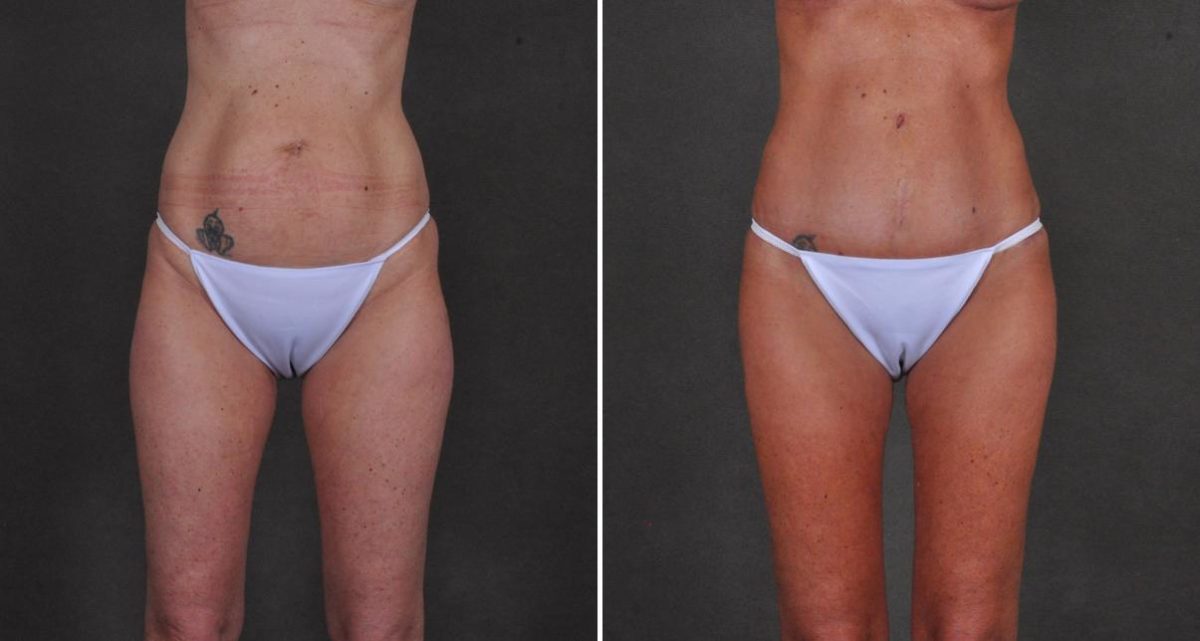 Tummy Tuck Before and After Photos in Omaha, NE, Case 10427