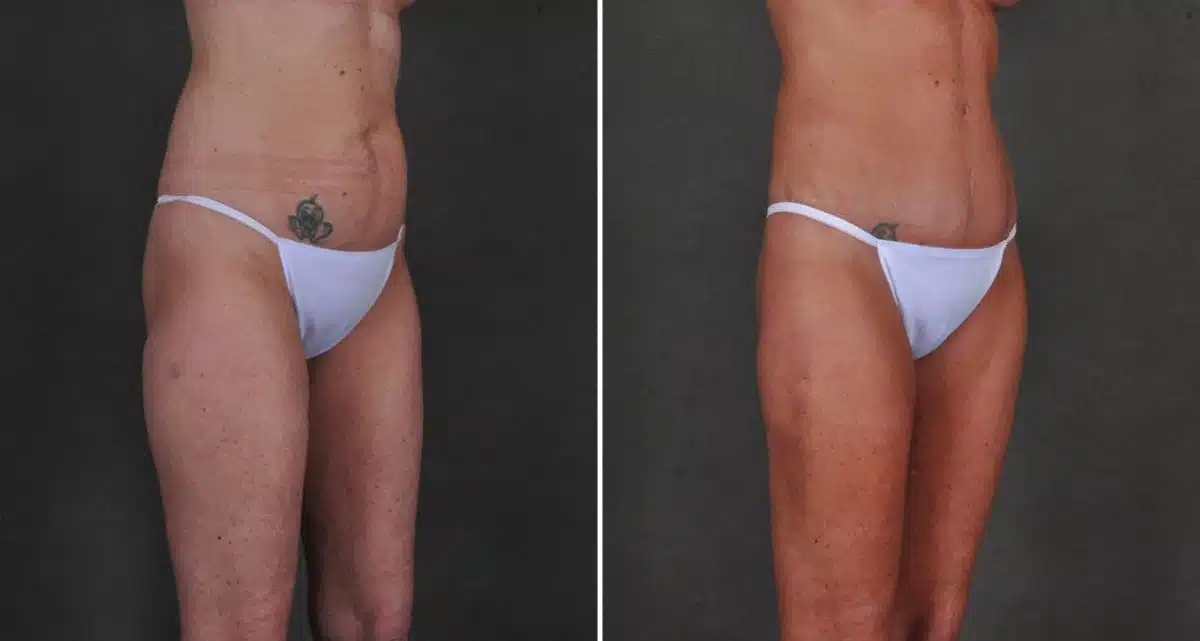 Tummy Tuck Before and After Photos in Omaha, NE, Case 10427