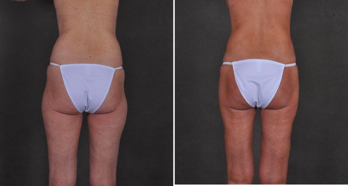 Case 10427, Tummy Tuck Before and After Photos Tummy Tuck Before and After Photos in Omaha, NE, Case 10427