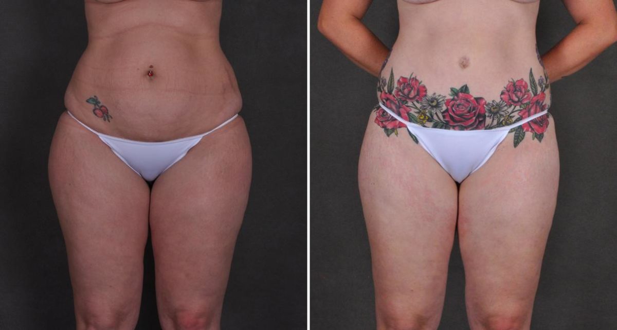 Case 10452, Tummy Tuck Before and After Photos Tummy Tuck Before and After Photos in Omaha, NE, Case 10452