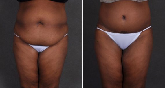 Tummy Tuck Before and After Photos in Omaha, NE, Case 9877