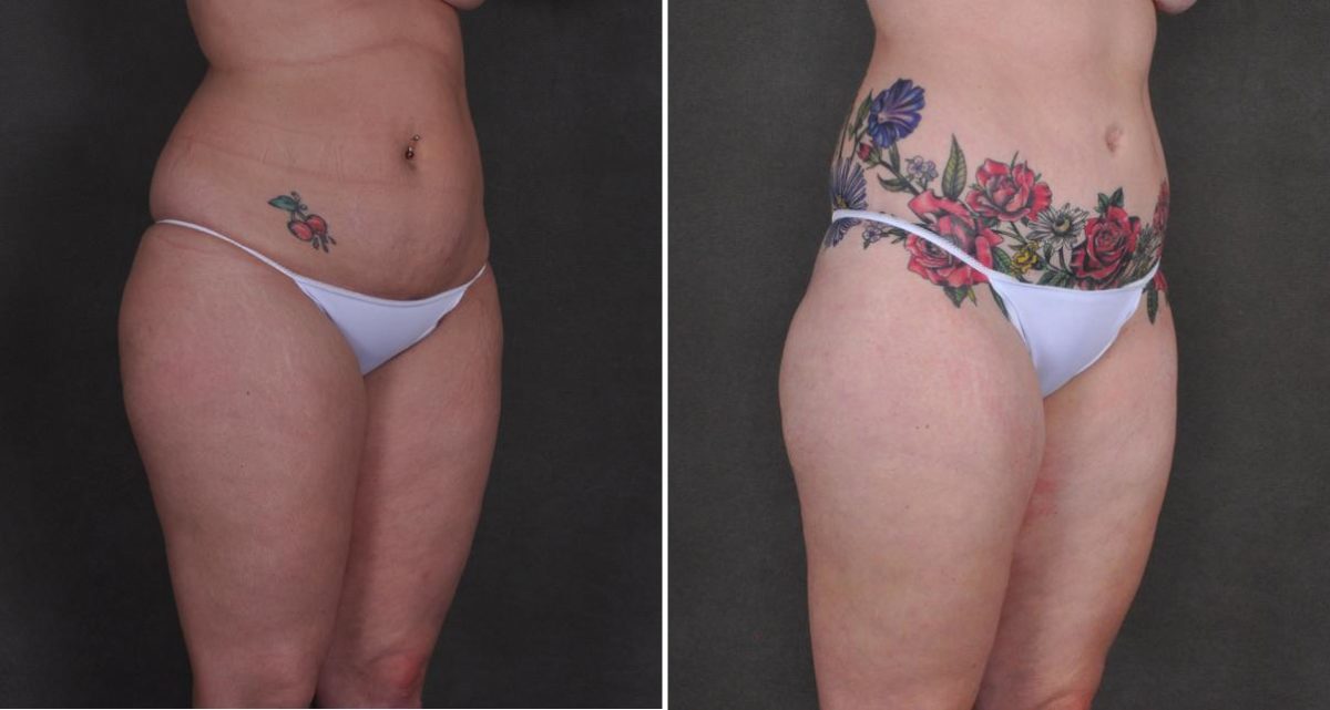 Case 10452, Tummy Tuck Before and After Photos Tummy Tuck Before and After Photos in Omaha, NE, Case 10452