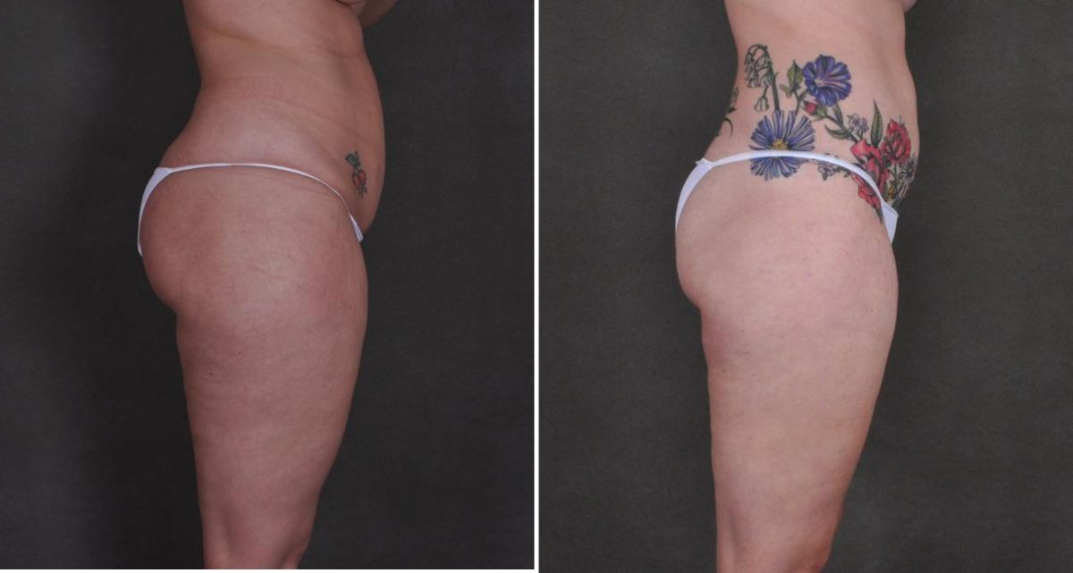 Tummy Tuck Before and After Photos in Omaha, NE, Case 10452