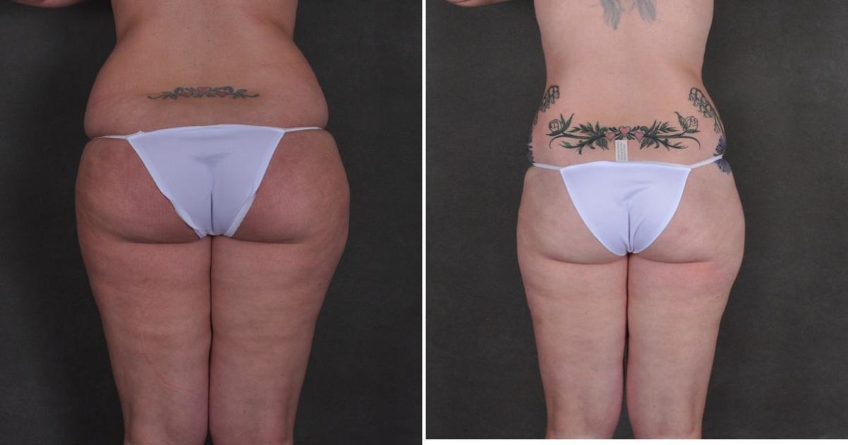 Tummy Tuck Before and After Photos in Omaha, NE, Case 10452