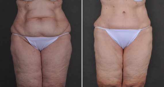 Tummy Tuck Before and After Photos in Omaha, NE, Case 10489