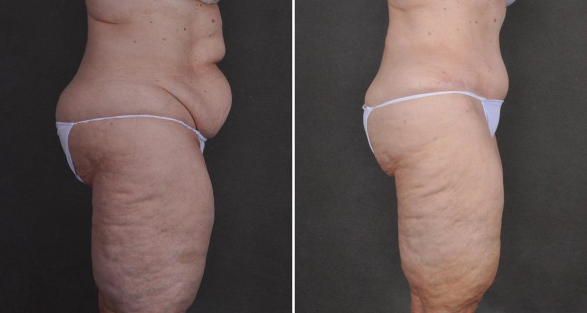 Tummy Tuck Before and After Photos in Omaha, NE, Case 10489