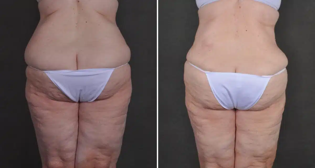 Tummy Tuck Before and After Photos in Omaha, NE, Case 10489