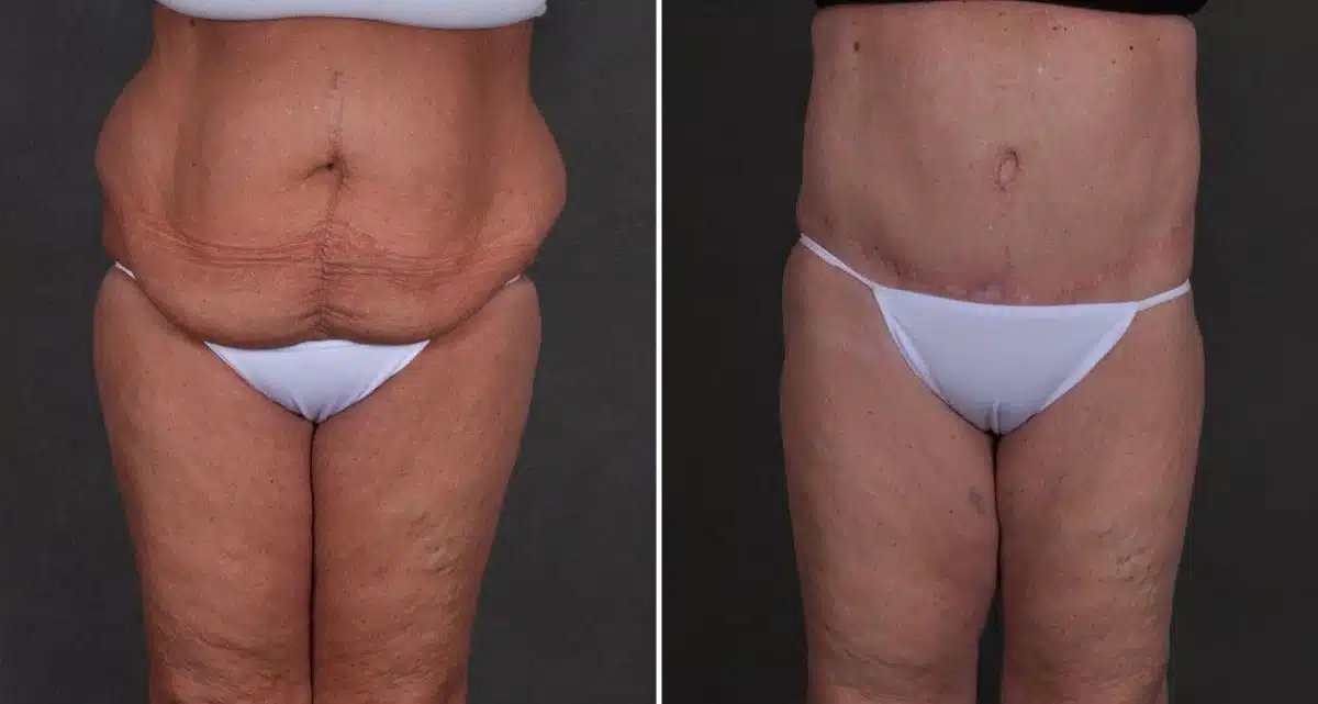 Tummy Tuck Before and After Photos in Omaha, NE, Case 9897