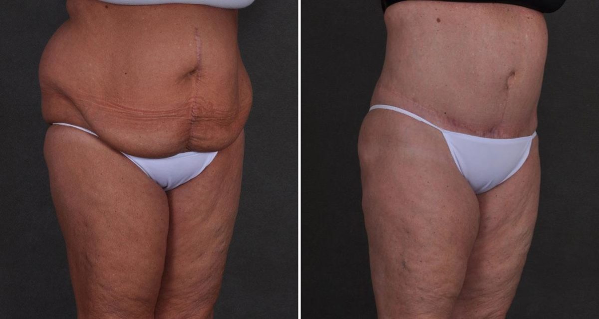 Tummy Tuck Before and After Photos in Omaha, NE, Case 9897