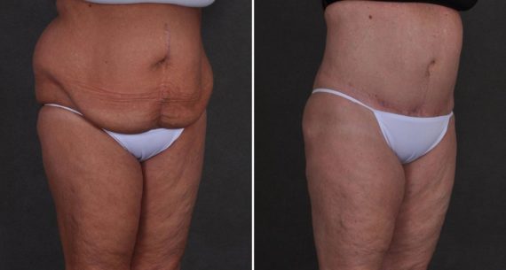 Tummy Tuck Before and After Photos in Omaha, NE, Case 9897