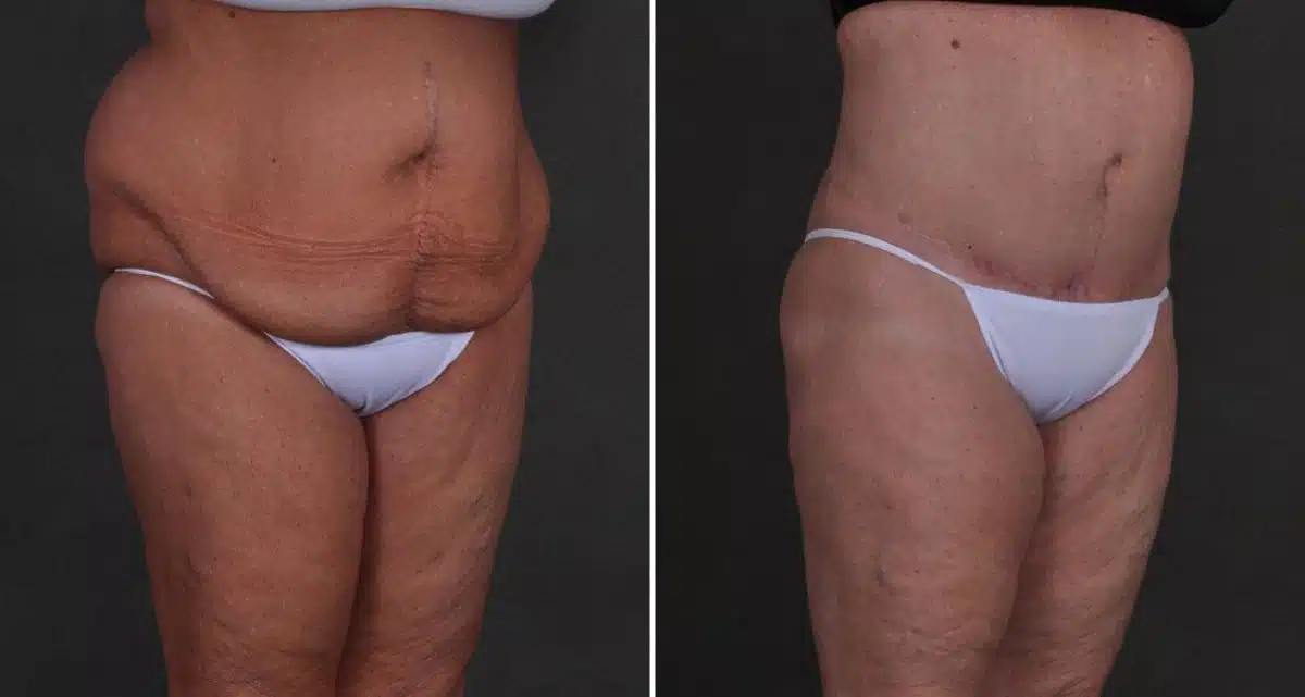 Liposuction Before and After Photos in Omaha, NE, Case 9906